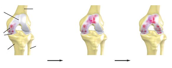 The degree of knee joint