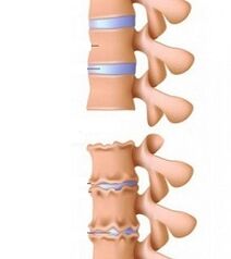 Ramp stage of neck osteochondrosis