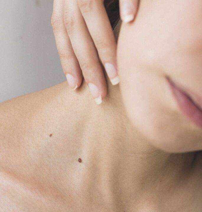 Neck stiffness is one of the early symptoms of cervical osteochondrosis