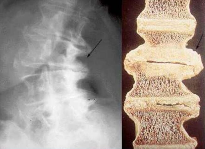 Damage to vertebrae caused by thoracic osteochondrosis