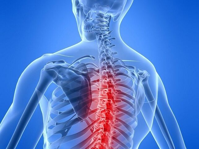 Thoracic osteochondrosis