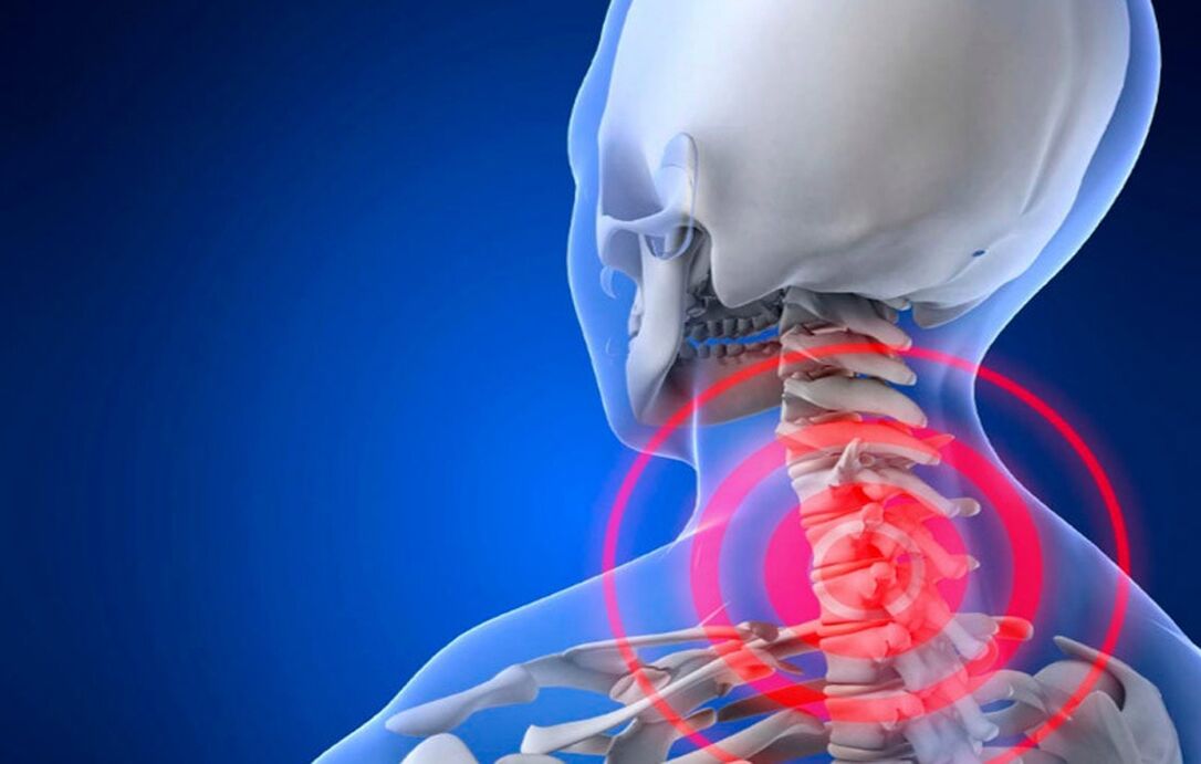 cervical osteochondrosis