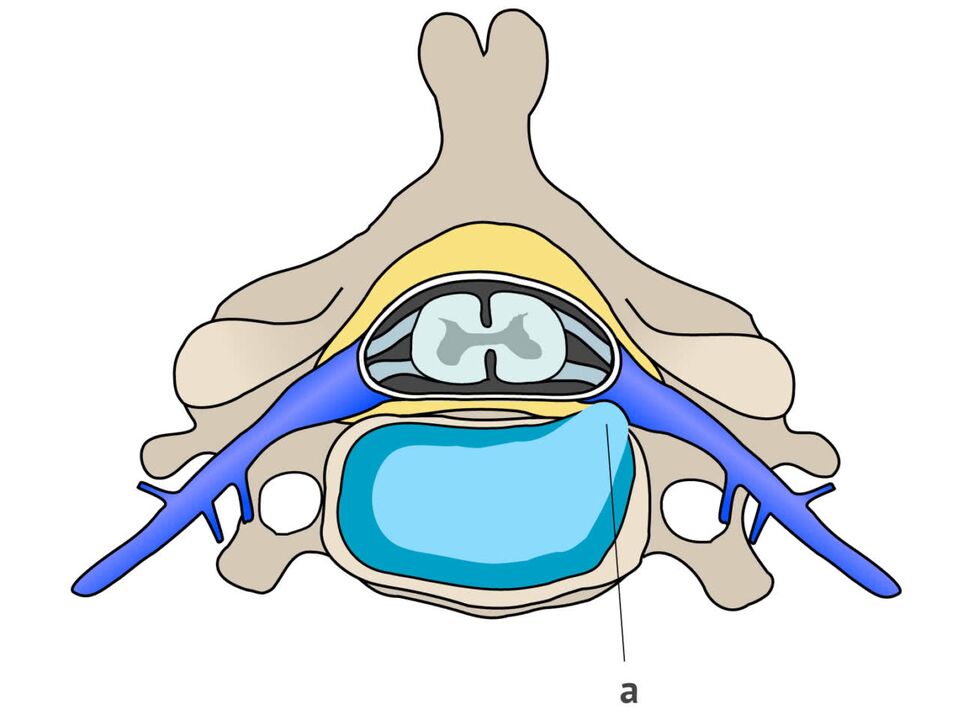 Intervertebral hernia combined with cervical osteochondrosis